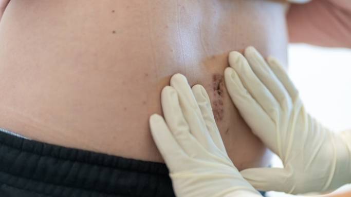 What to Expect Hernia Surgery