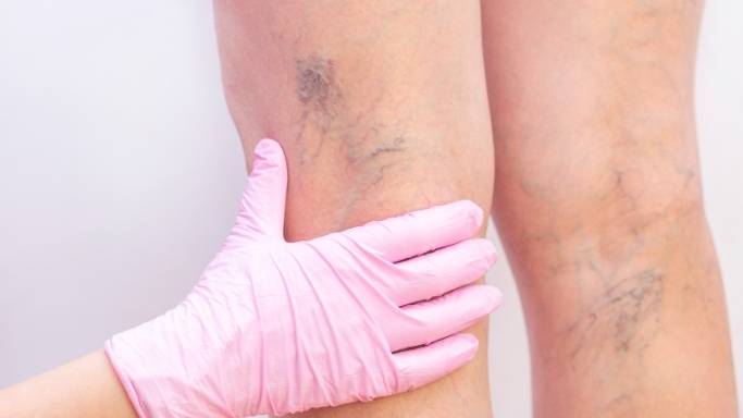 5 Warning Signs Varicose Veins